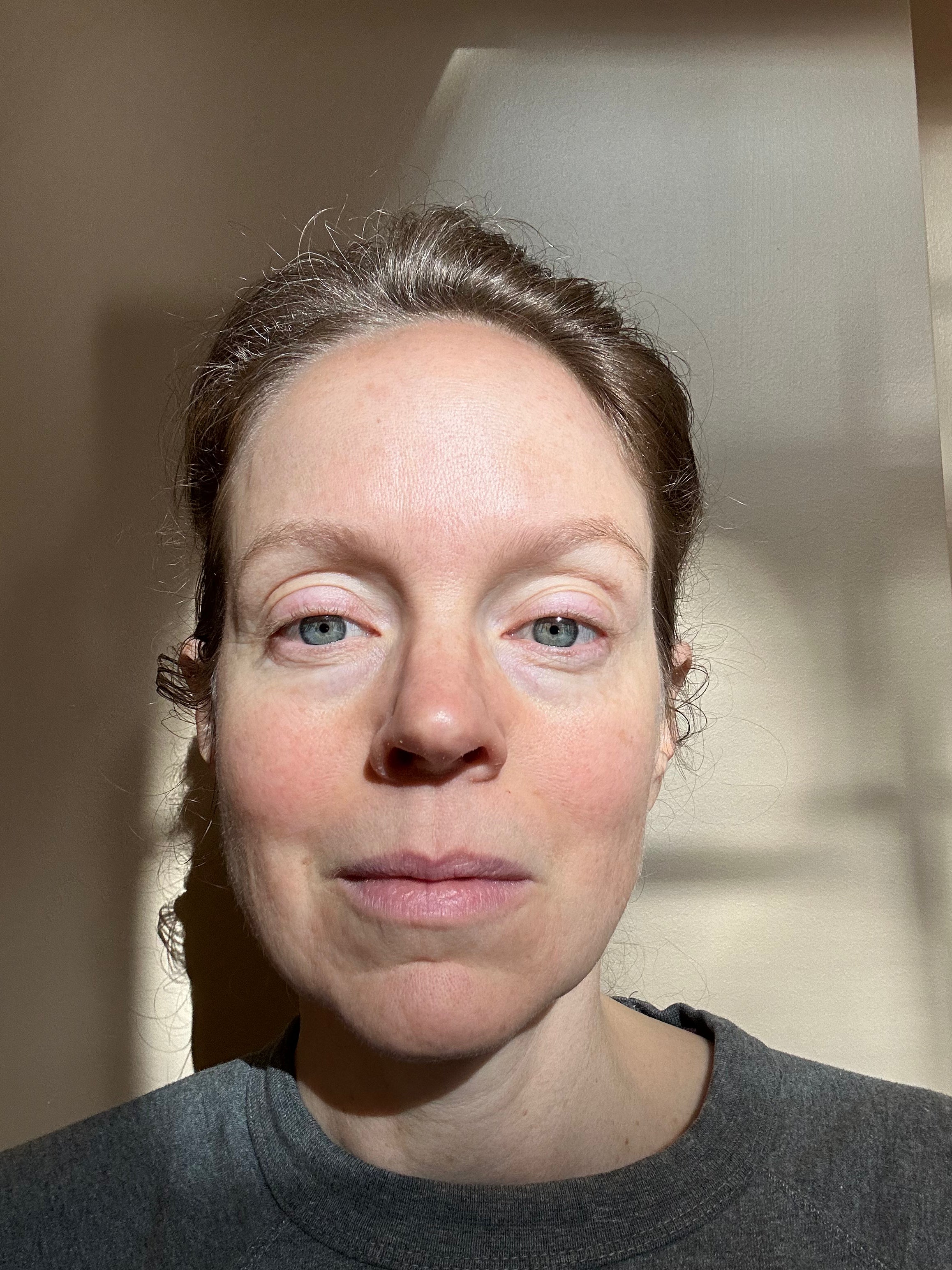 Face after using the FaceSculpter facial muscle toning device