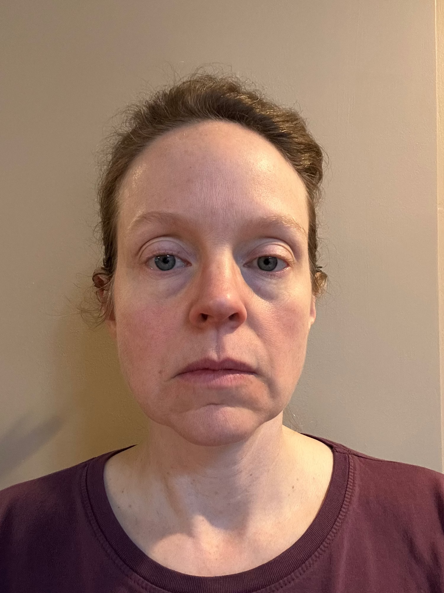 Customer before beginning FaceSculpter facial toning